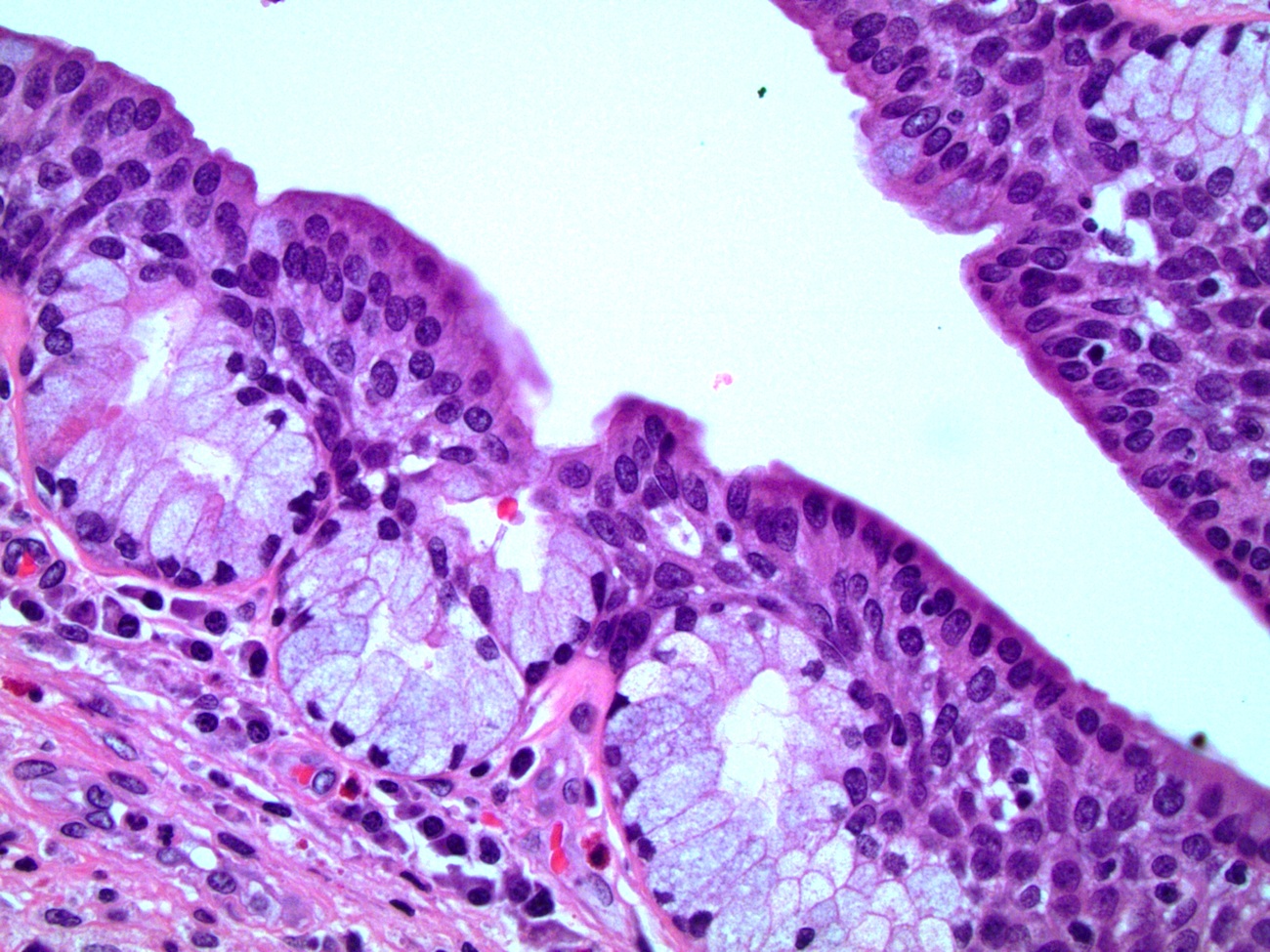 Penile intraepithelial (juxtaepithelial) glands