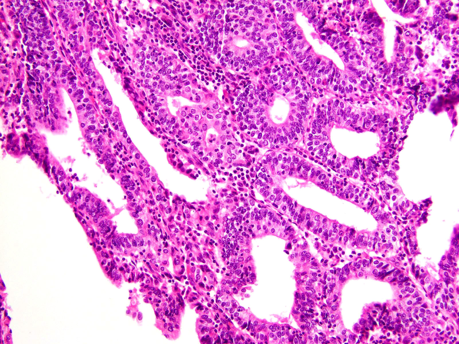 Tumor infiltrating lymphocytes