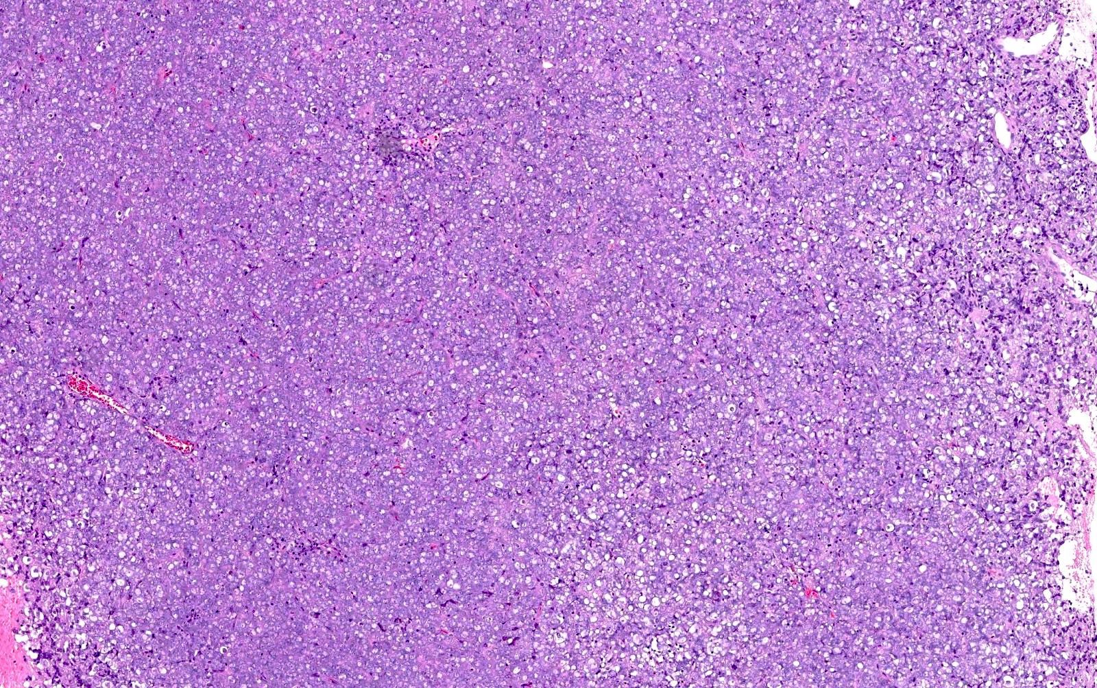 Tumor cells in sheets, no gland or papillary formation