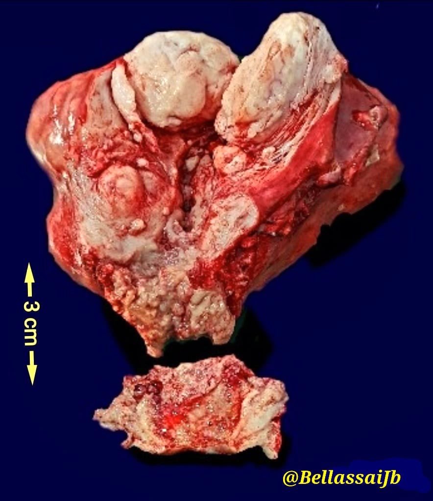 Clear cell carcinoma