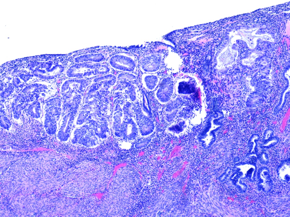 Неоплазия железистого. Папилломатоз шейки матки гистология. Плоскоклеточная метаплазия эндометрия.