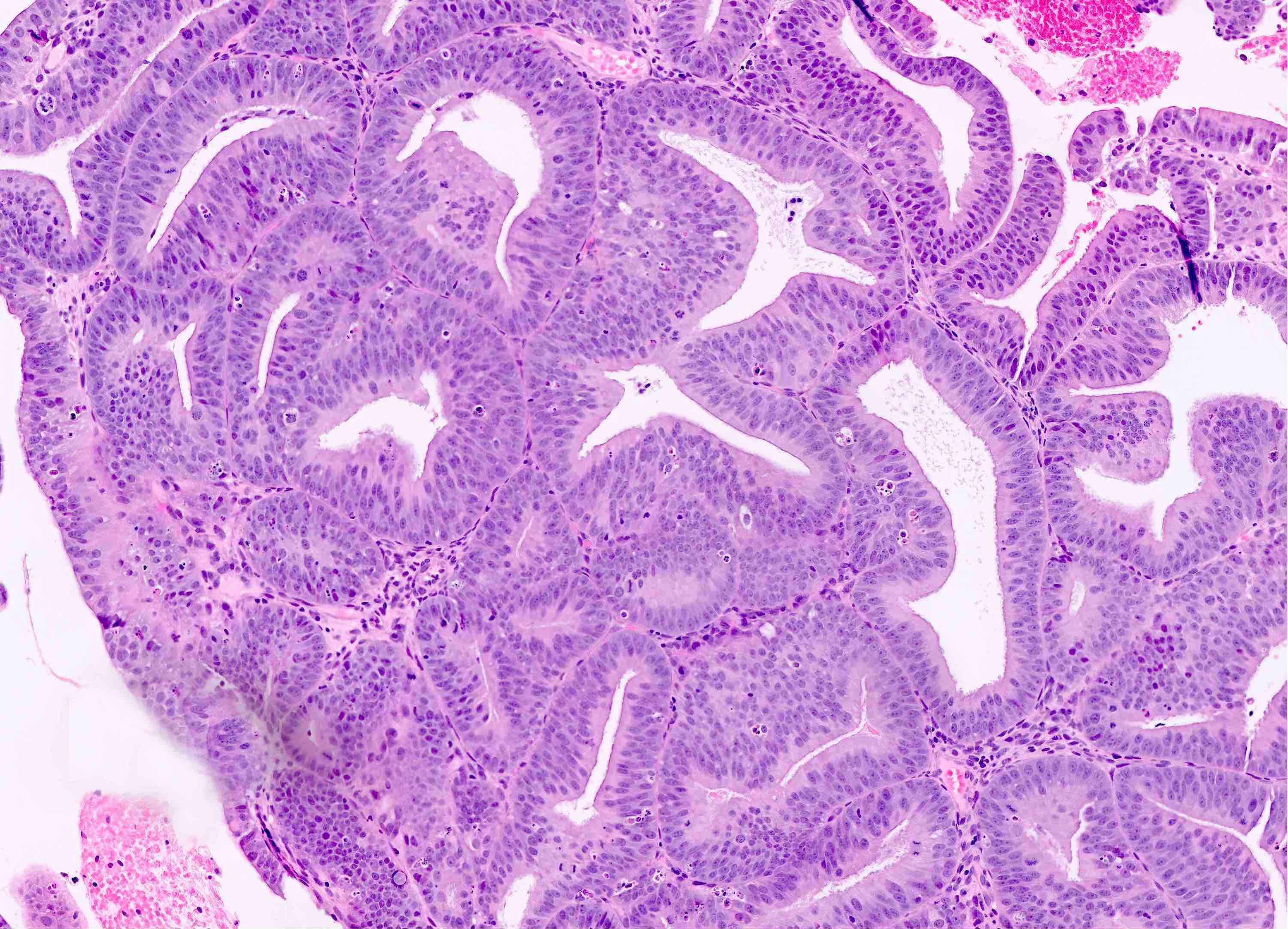 endometrial cancer pathology outlines