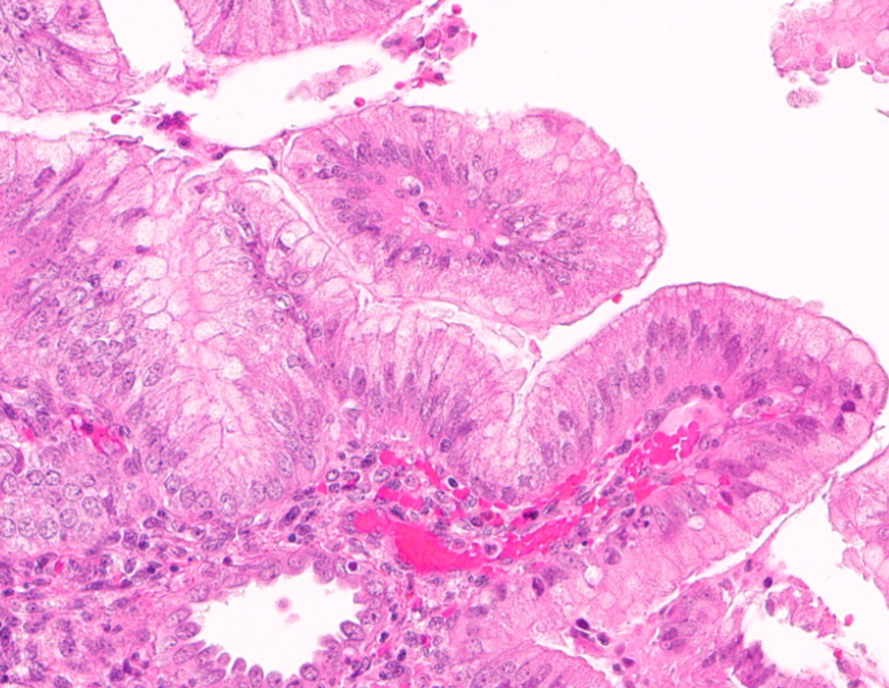 Endometrioid adenocarcinoma with mucinous differentiation