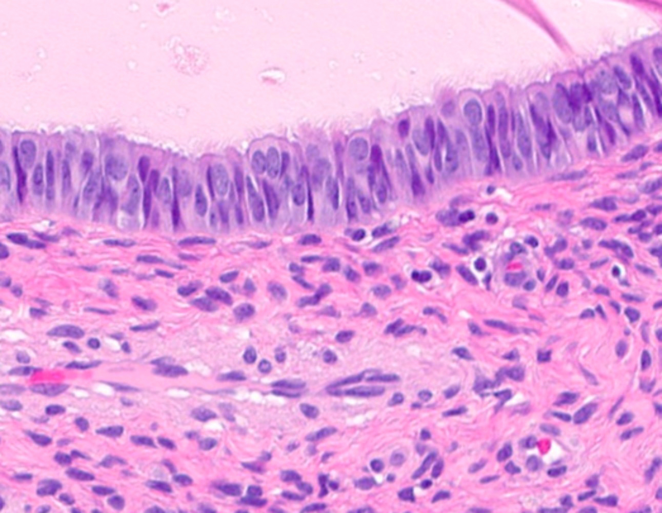 Tubal (ciliated cell) metaplasia