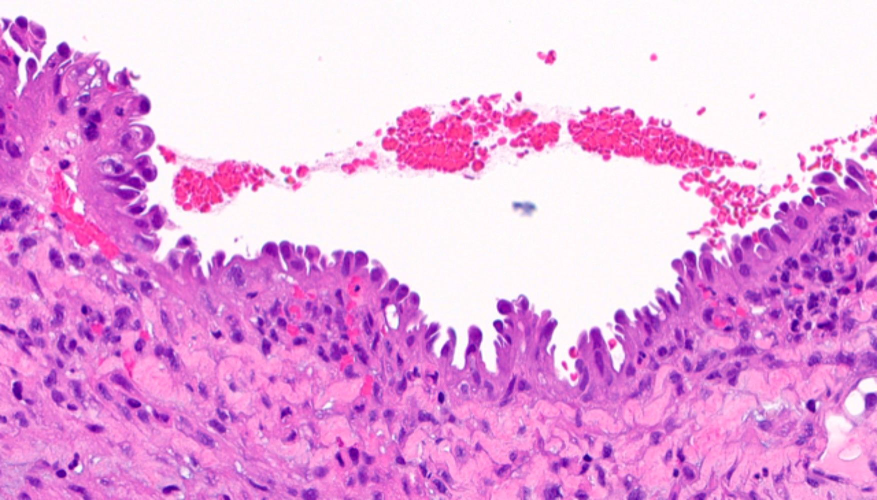 Papillary syncytial metaplasia