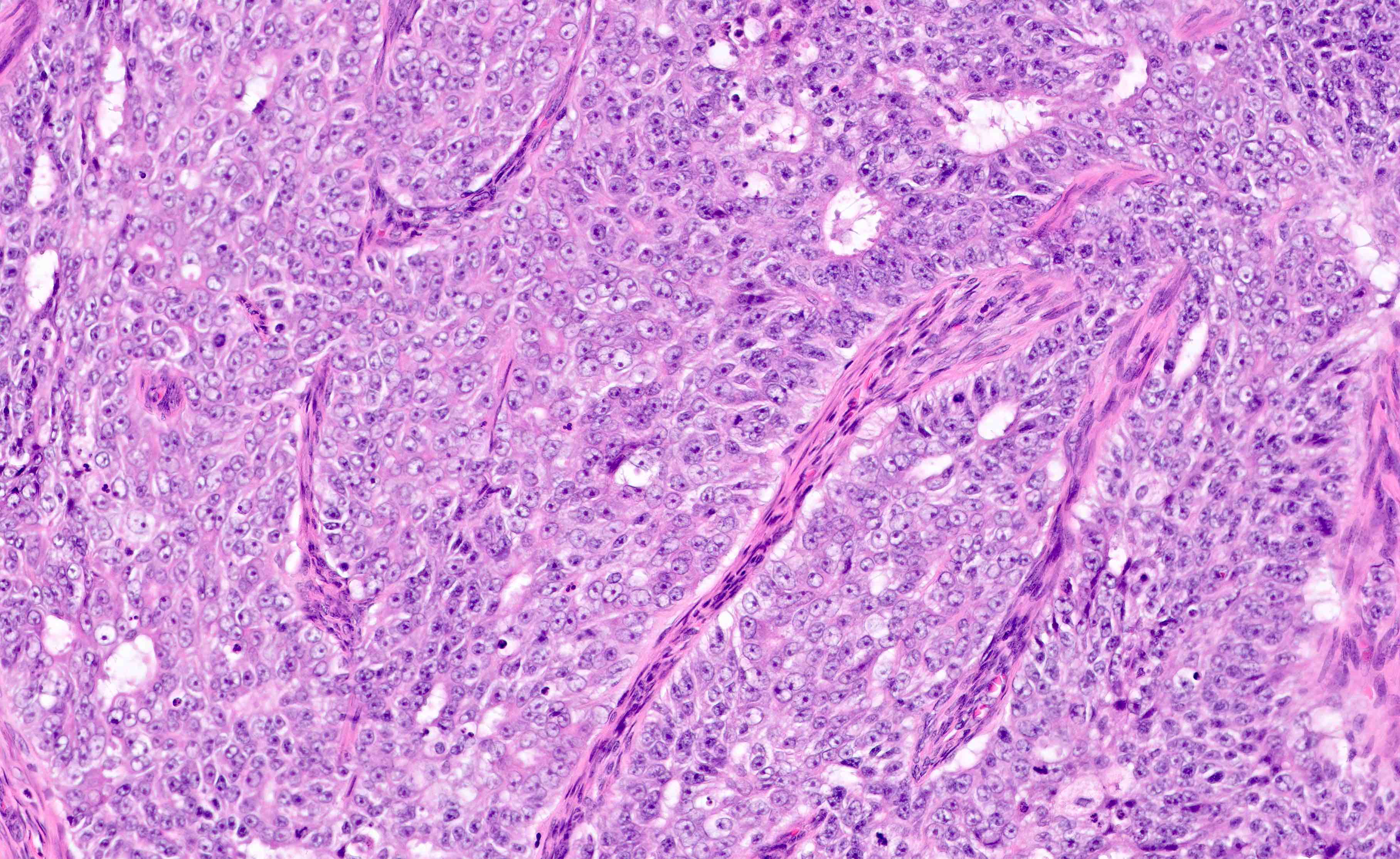 endometrial cancer pathology outlines)