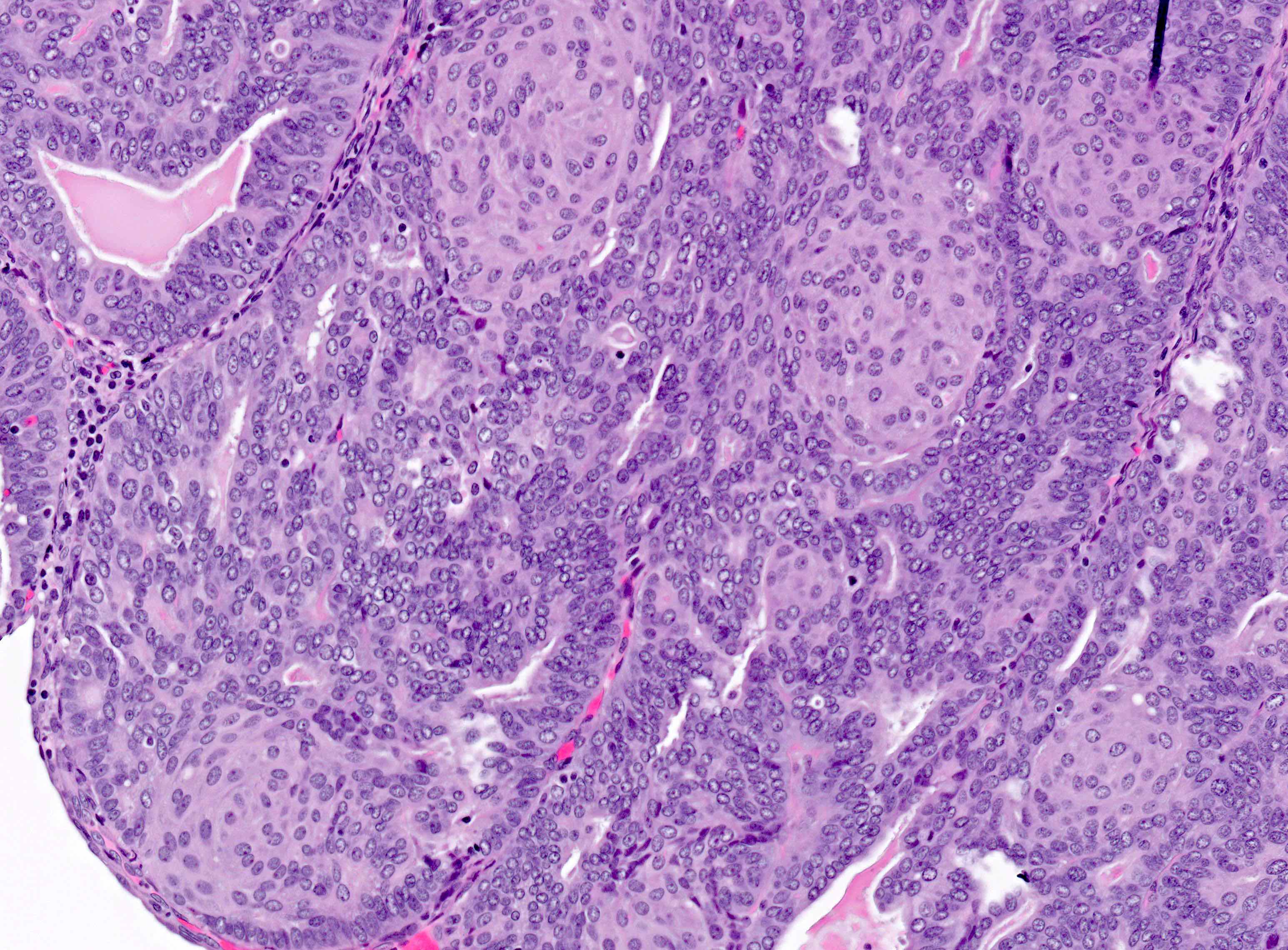 Papillary urothelial pathology outlines Papillary urothelial pathology outlines