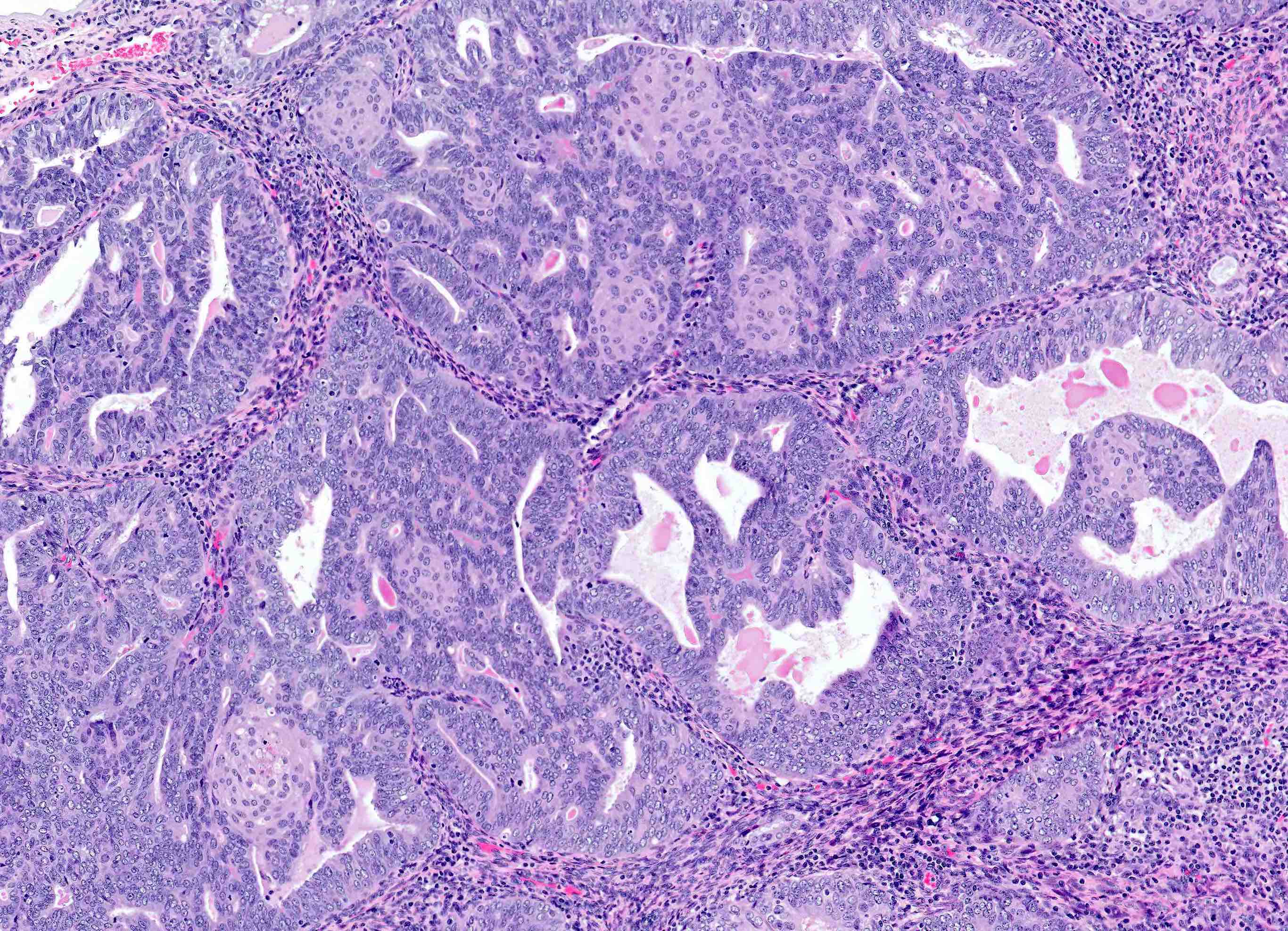 Papiloma urotelial pathology outlines
