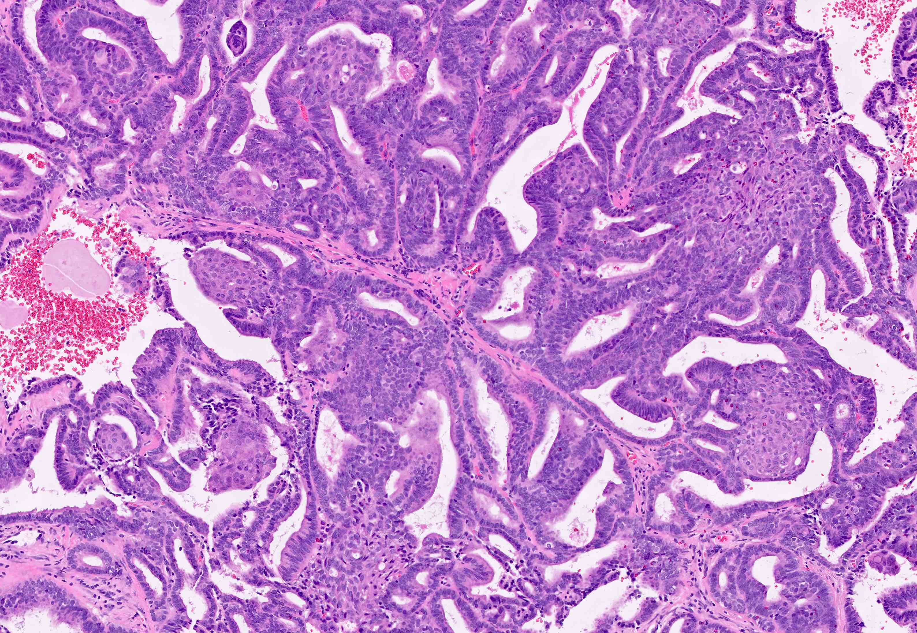 endometrial cancer pathology outlines