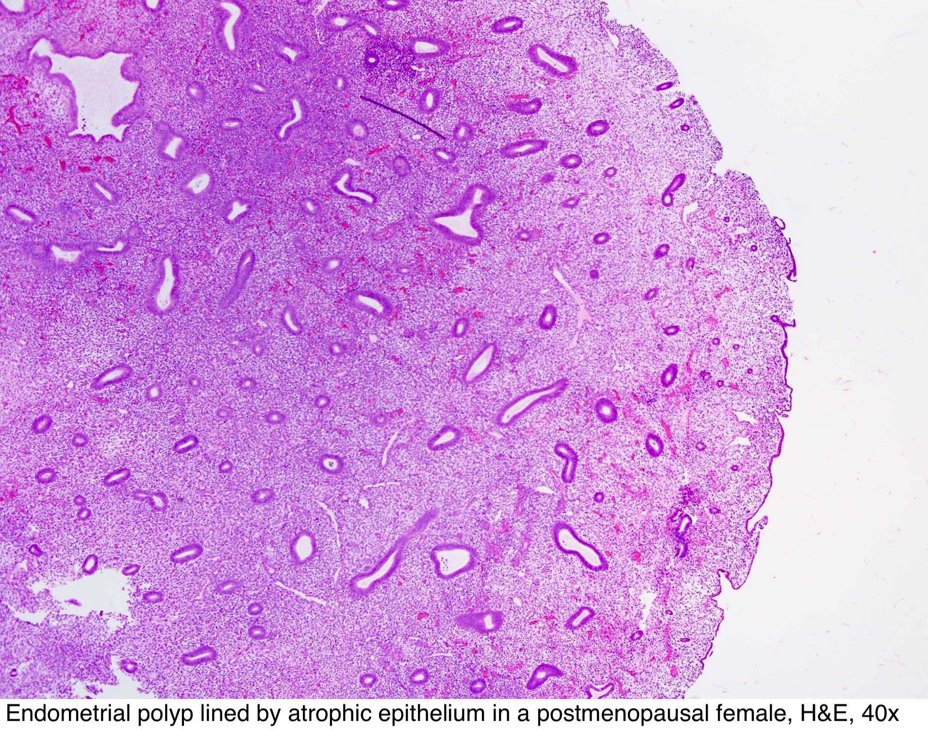 Pathology Outlines - Endometrial polyp