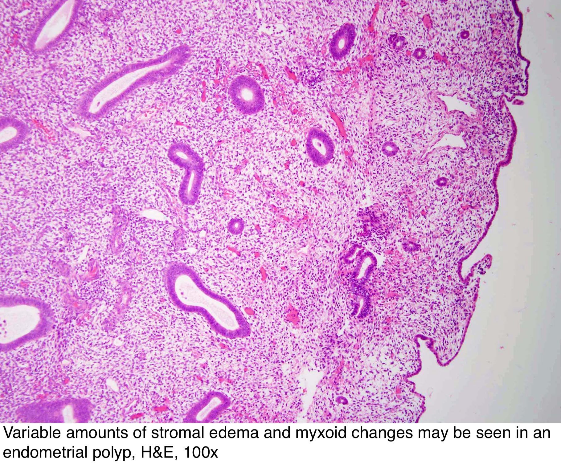 Pathology Outlines - Endometrial polyp.