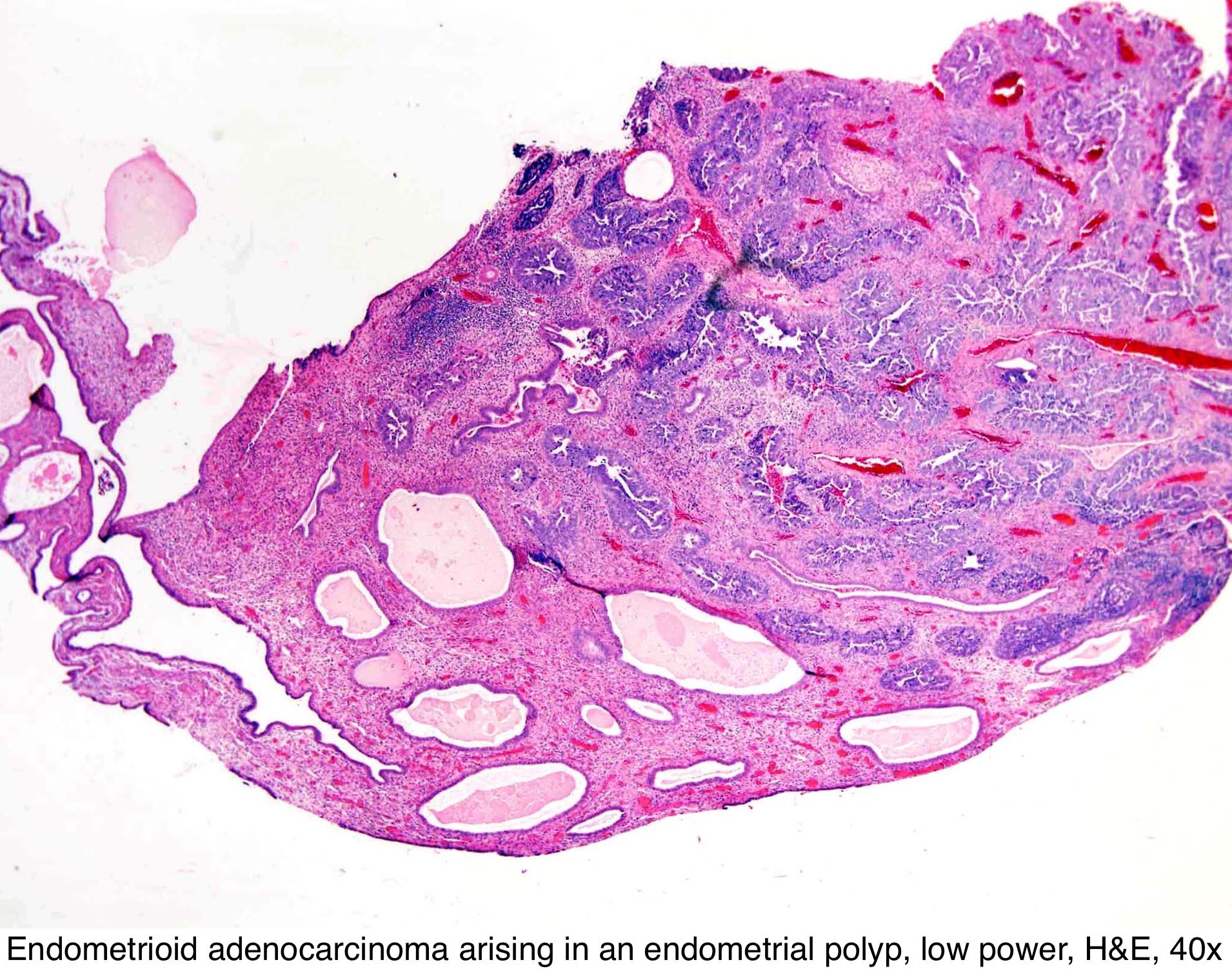 1910 x 1506 - jpeg. pathology outlines endometrial polyp. 