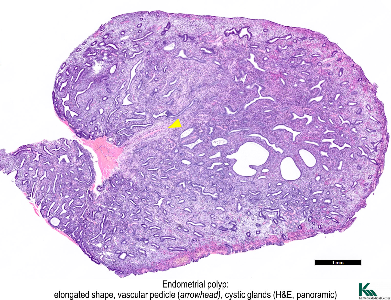 Pathology Outlines Endometrial Polyp.