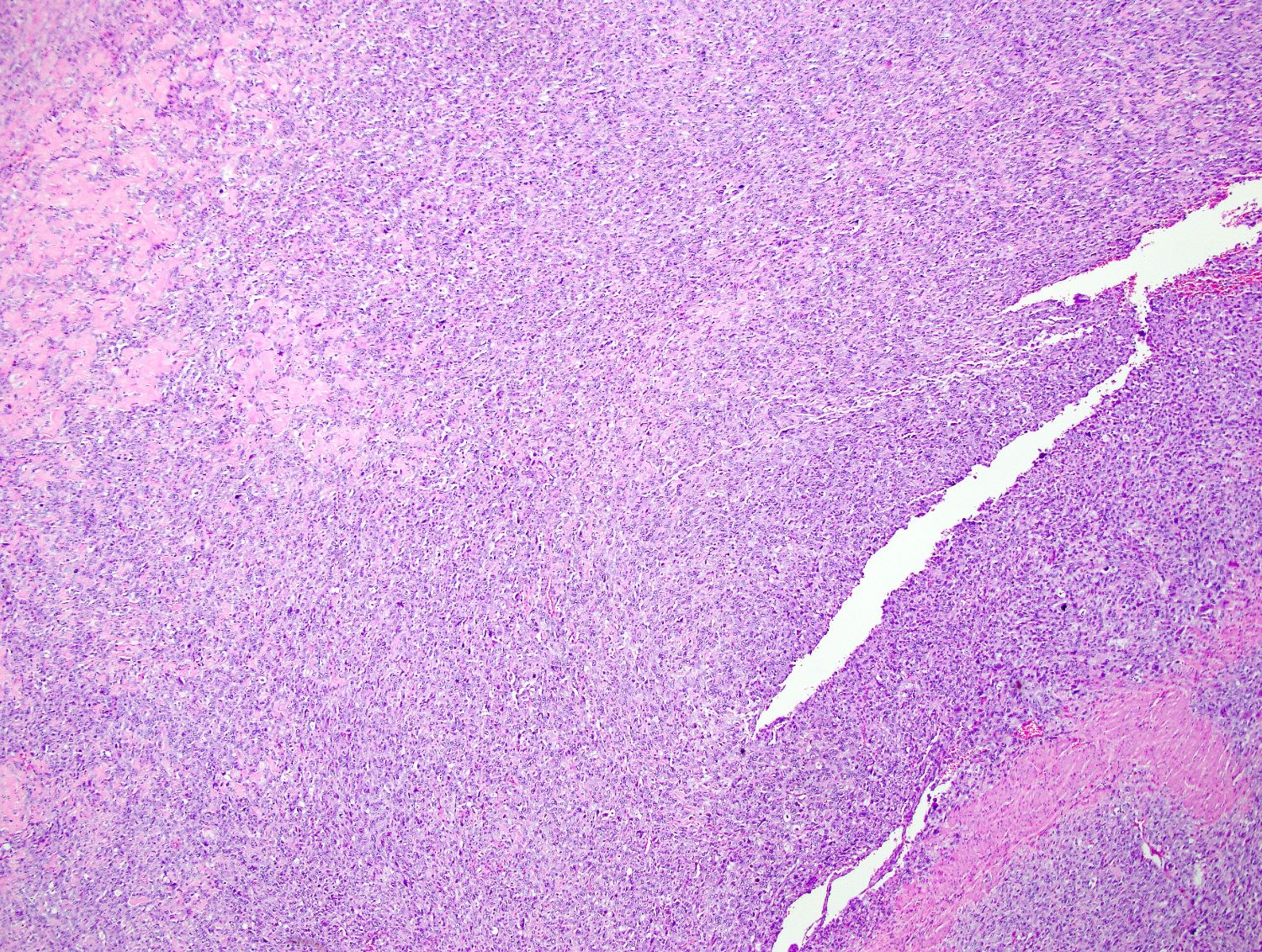 Epithelioid mesenchymal neoplasm
