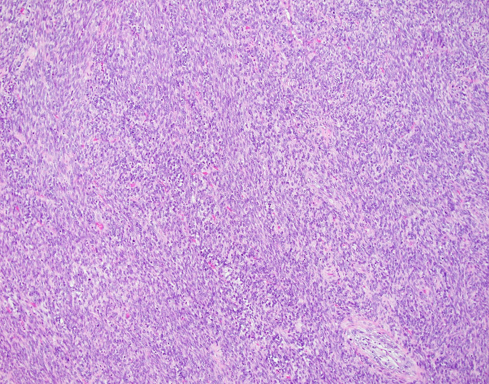 Spindle cell mesenchymal neoplasm