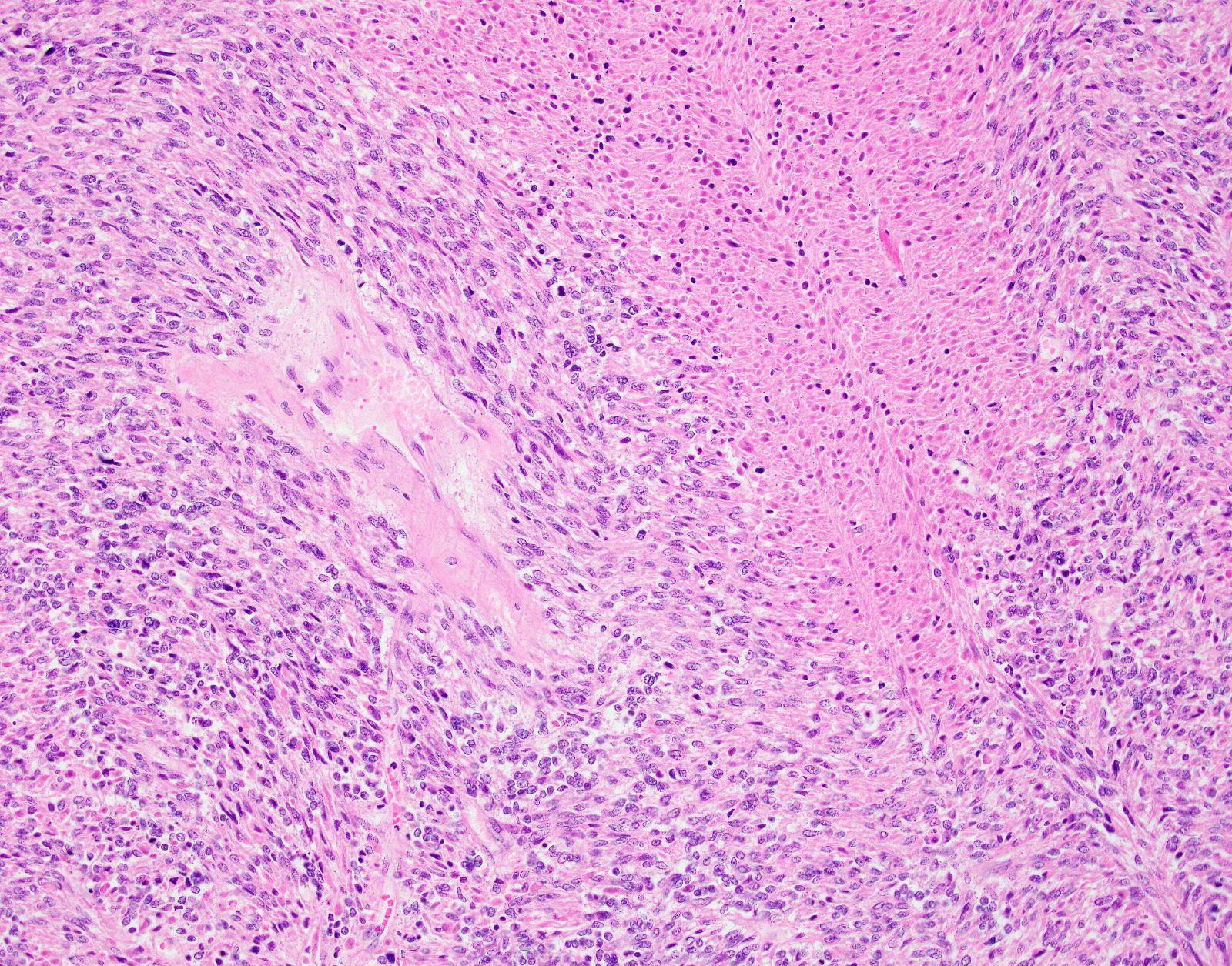 Tumor cell necrosis