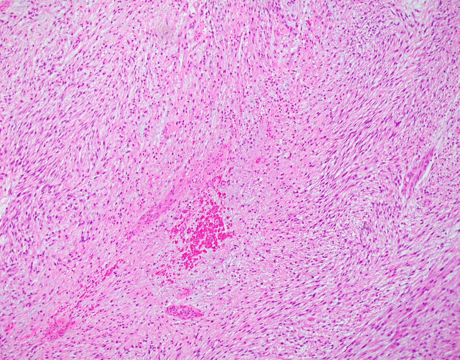 Myxoid mesenchymal neoplasm