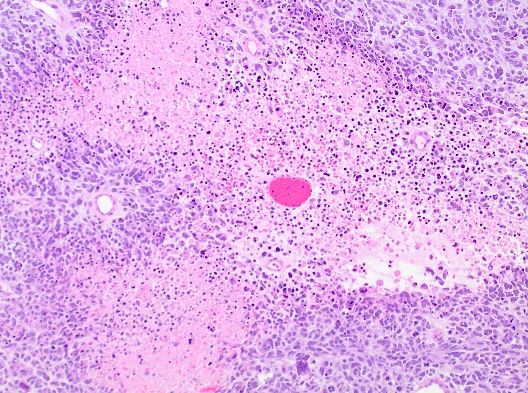 Tumor cell necrosis