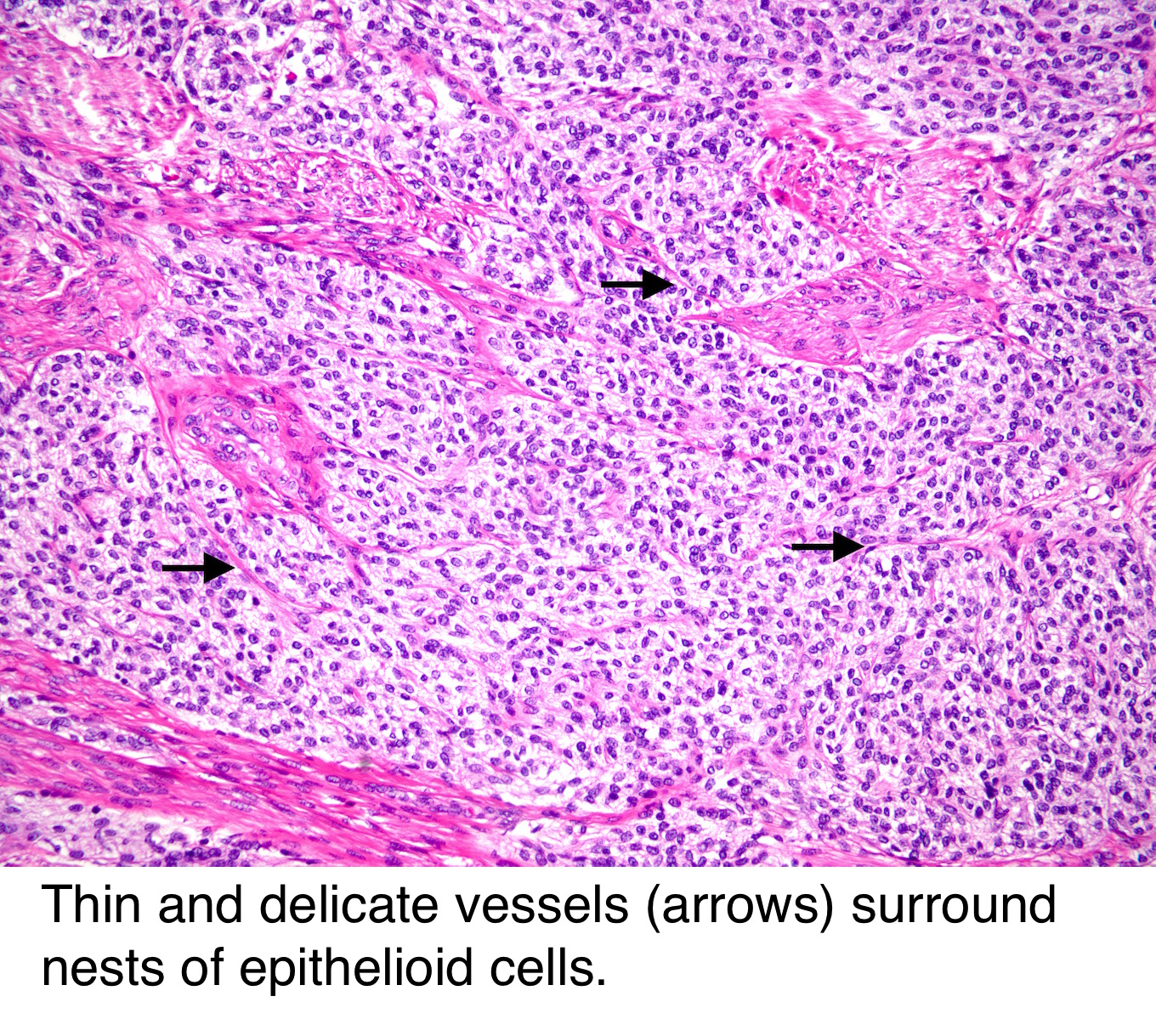 Pathology Outlines Perivascular epithelioid cell tumor