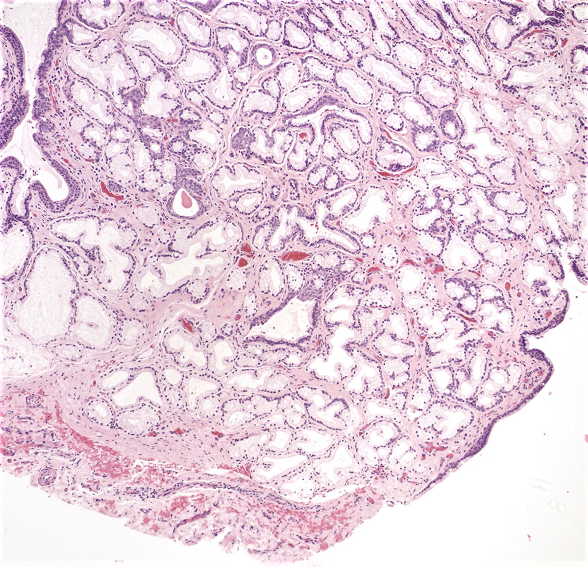 Bartholin cyst with adjacent Bartholin glands