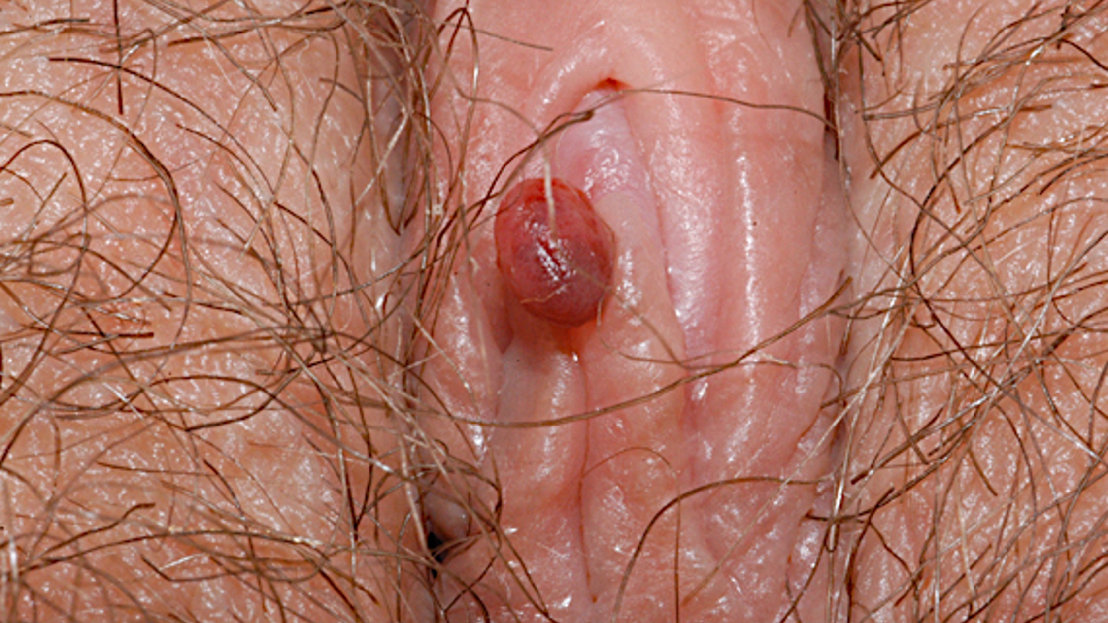 Vulvar polyp