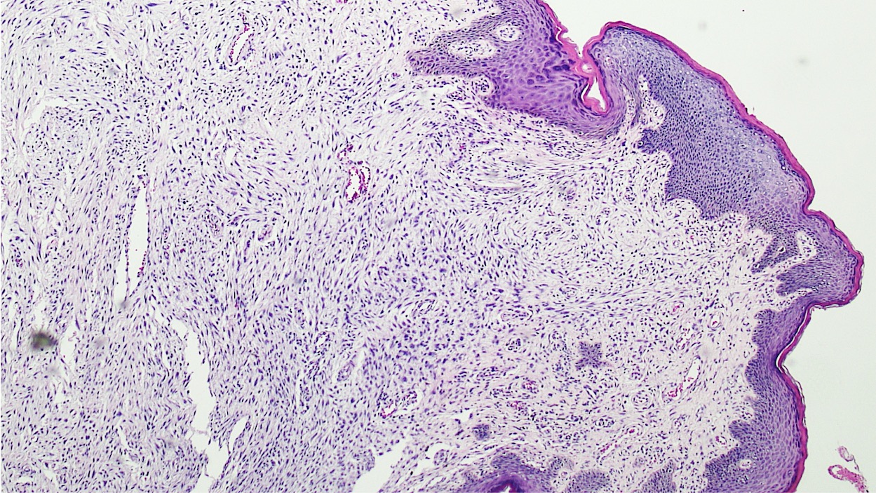 fibroepithelial papilloma skin