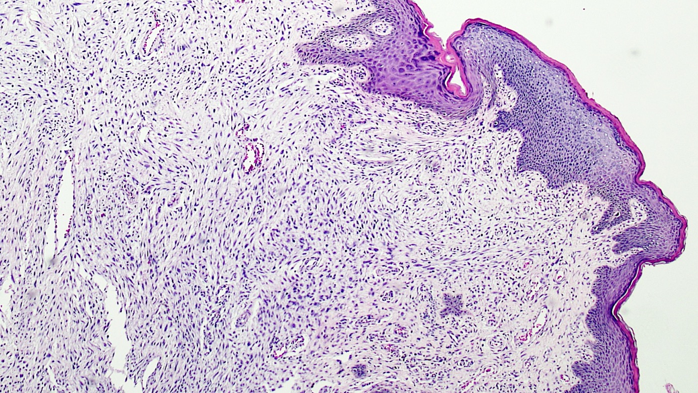 Fibroepithelial papilloma breast. Rosen's Breast Pathology, What causes fibroepithelial papilloma