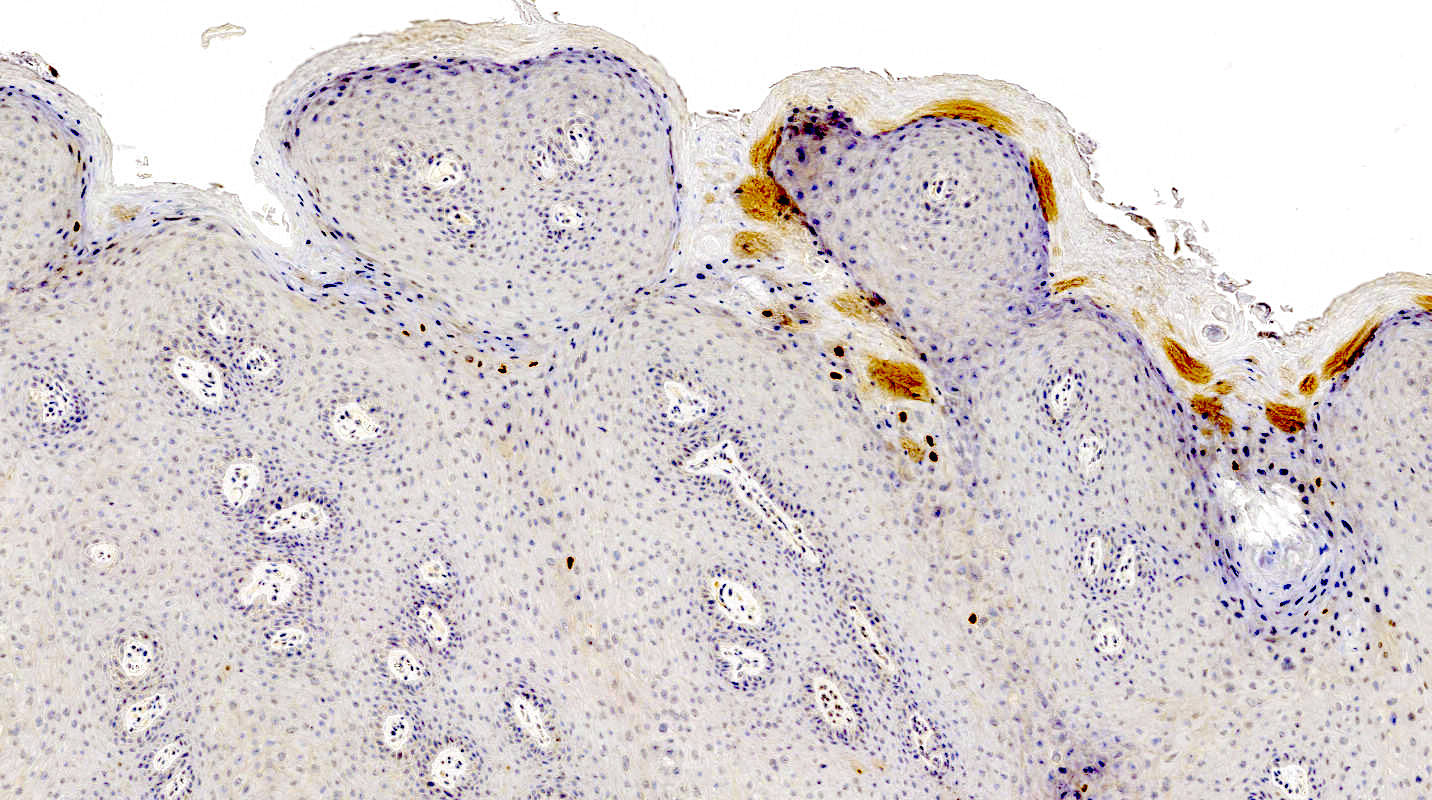 condyloma acuminata patológia körvonalazódik fonálféreg elleni gyógyszer