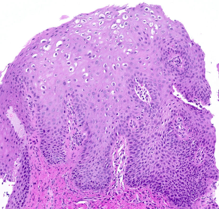urethral condyloma pathology