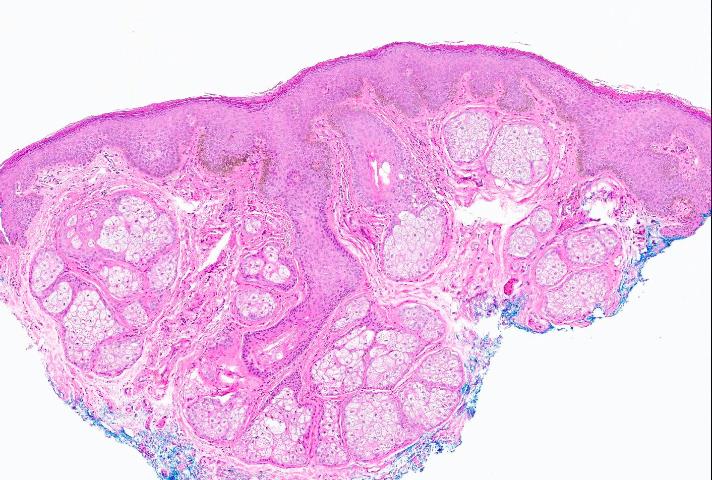 Mucosal melanotic macule