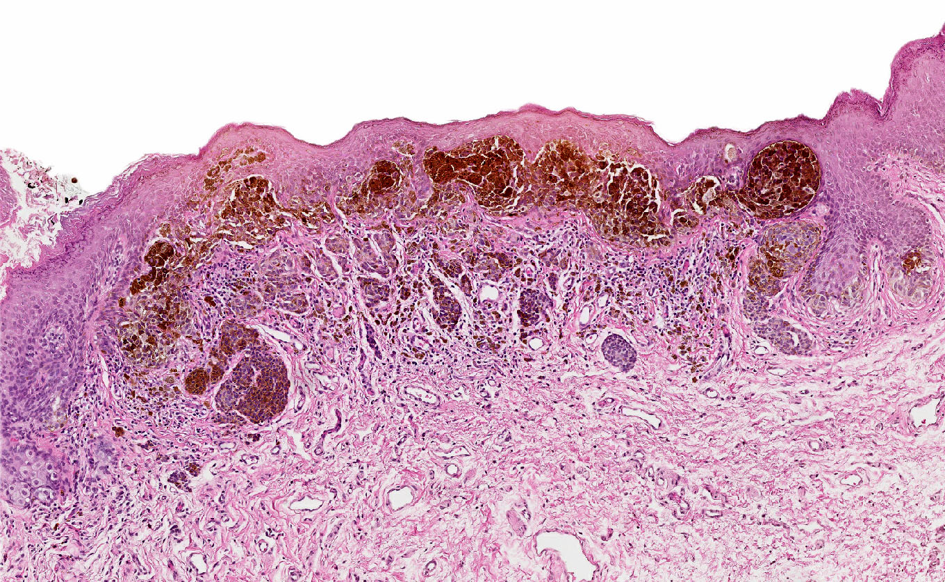 Atypical melanocytic nevus, genital type
