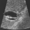 Ultrasound, mass forming extrahepatic cholangiocarcinoma