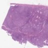 Mucinous tubular and spindle cell carcinoma