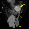 Nodular mass inguinal region