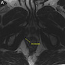 Lower rectal exophytic lesion