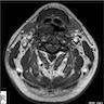 Right pharynx mass