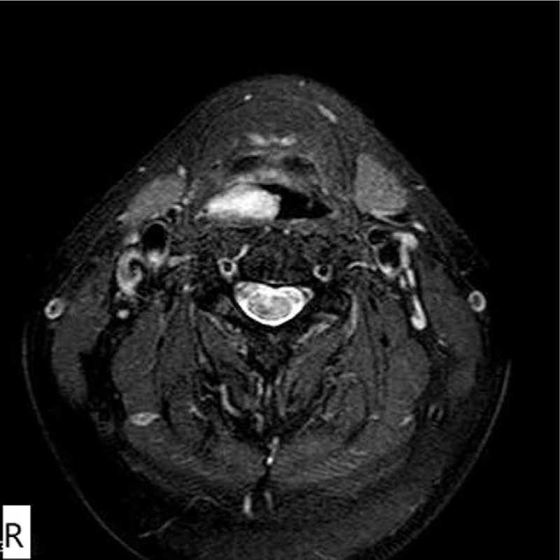 Hypopharyngeal mass