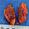 Acute hemorrhagic pancreatitis