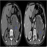 Hydatid cyst