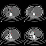 Giant endothelial cyst