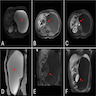 Giant endothelial cyst