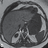 MRI normal adrenal glands