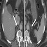 CT normal adrenal glands