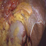 Right adrenal gland in situ