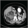 CT axial section showing mass in right renal gland