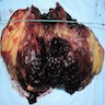 Well circumscribed<br>tumor with multiple<br>areas of hemorrhage