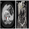 CT imaging of advanced ACC