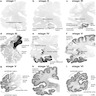 Stages of Braak NFT spread