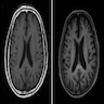 Cortical atrophy on magnetic resonance imaging