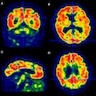 Pittsburgh compound B PET imaging